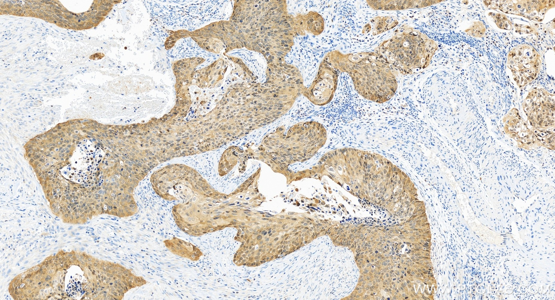 Immunohistochemical analysis of paraffin-embedded human cervical cancer tissue slide using 81373-10-RR (P16-INK4A antibody) at dilution of 1:500 (under 20x lens). Heat mediated antigen retrieval with Tris-EDTA buffer (pH 9.0). Immunohistochemistry (IHC) staining of human cervical cancer tissue using P16-INK4A Recombinant antibody (81373-10-RR)