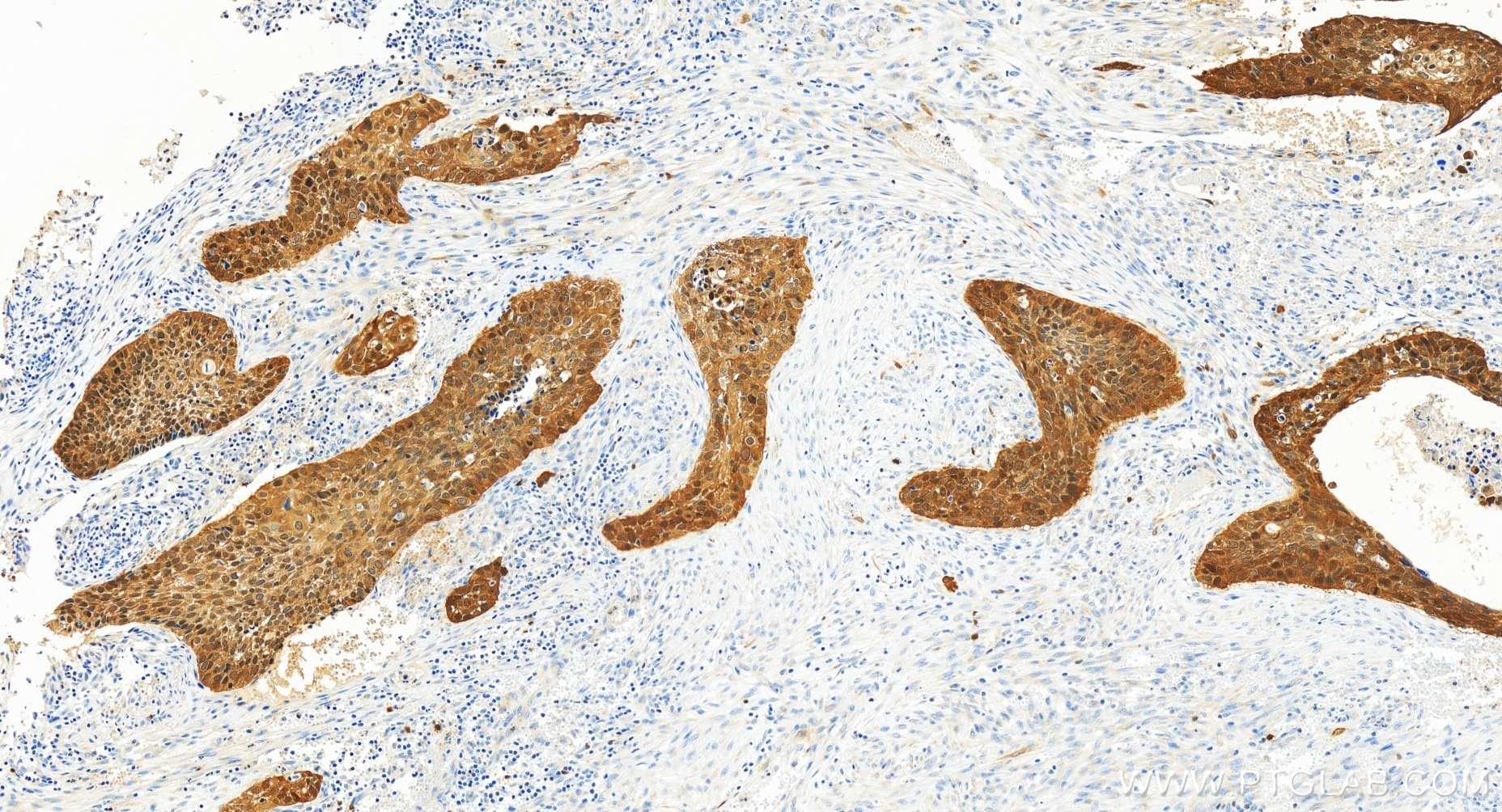 Immunohistochemistry (IHC) staining of human cervical cancer tissue using P16-INK4A Recombinant antibody (81373-8-RR)