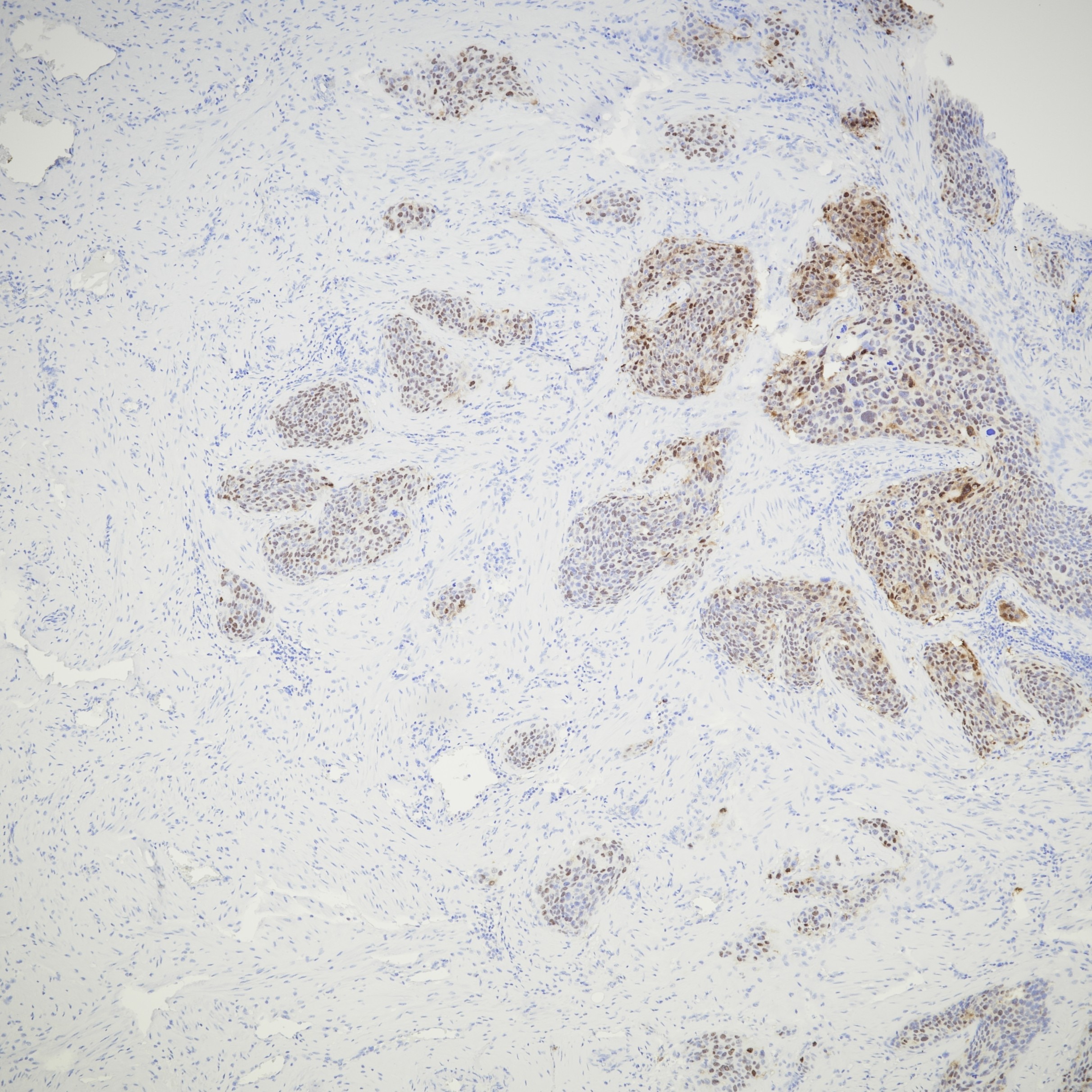 IHC staining of human cervical cancer using 81373-8-RR Immunohistochemistry (IHC) staining of human cervical cancer tissue using CDKN2A/P16-INK4A Recombinant monoclonal antibody (81373-8-RR)