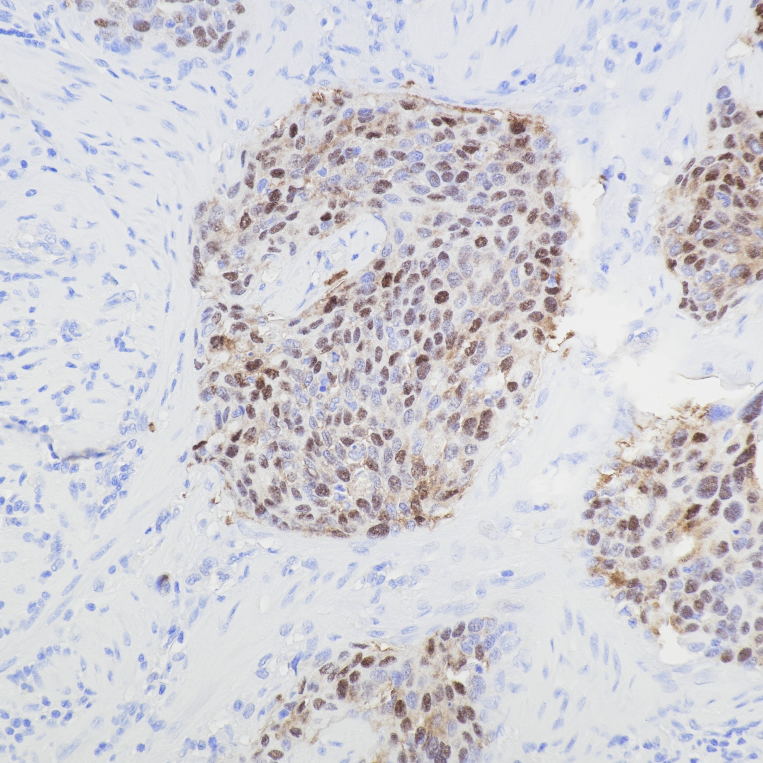 IHC staining of human cervical cancer using 81373-8-RR Immunohistochemistry (IHC) staining of human cervical cancer tissue using CDKN2A/P16-INK4A Recombinant monoclonal antibody (81373-8-RR)