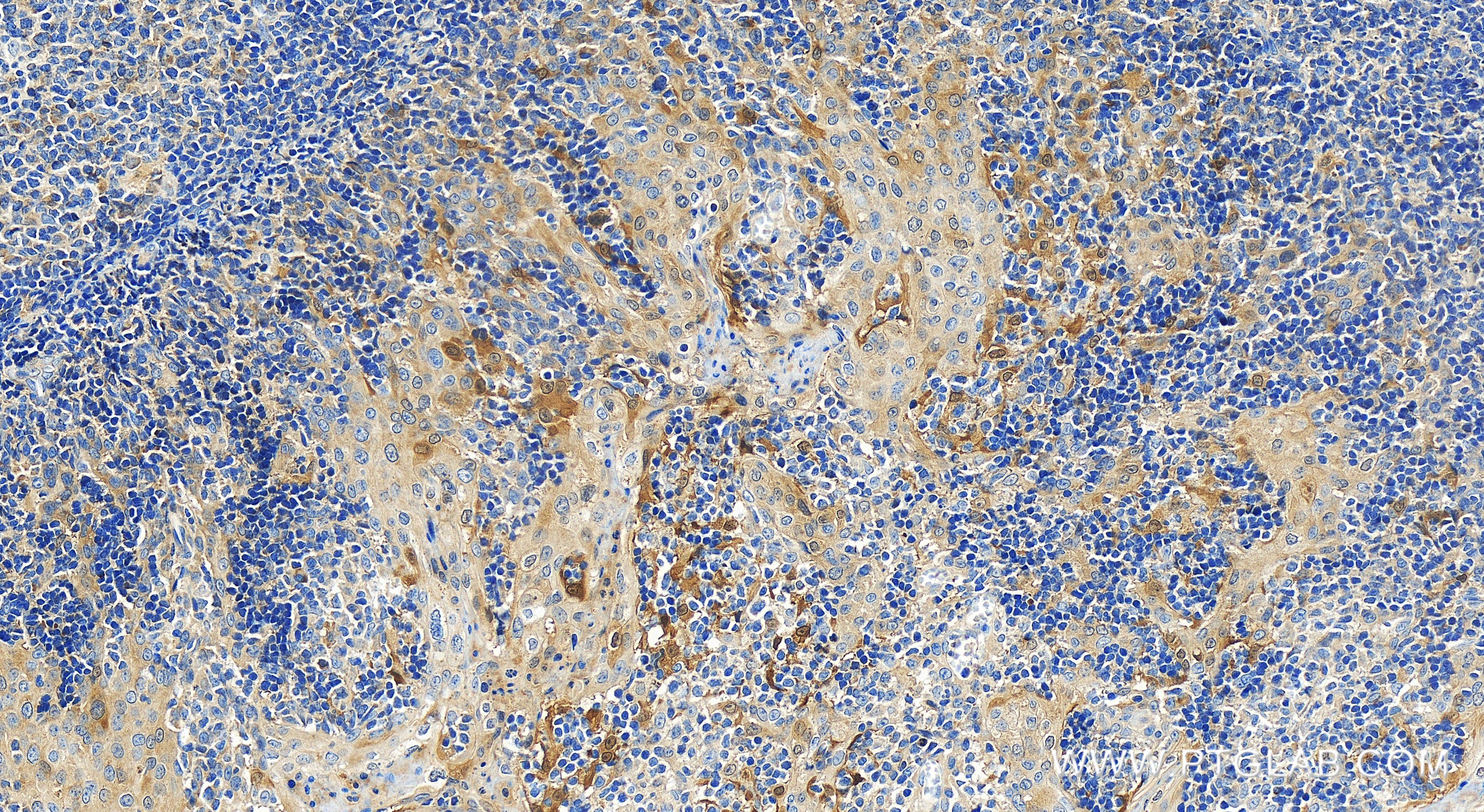 Immunohistochemistry (IHC) staining of human tonsillitis tissue using P16-INK4A Recombinant antibody (81373-8-RR)