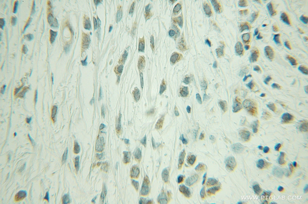 Immunohistochemistry (IHC) staining of human breast cancer tissue using P21 Polyclonal antibody (10240-1-AP)