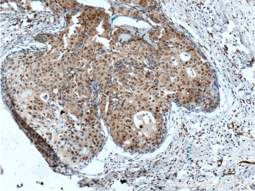 Immunohistochemistry (IHC) staining of human breast cancer tissue using P21 Polyclonal antibody (10355-1-AP)