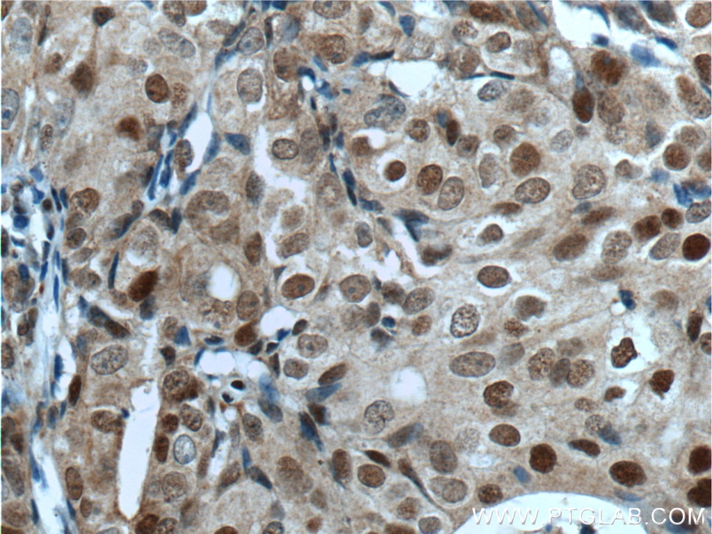 Immunohistochemistry (IHC) staining of human breast cancer tissue using P21 Polyclonal antibody (10355-1-AP)
