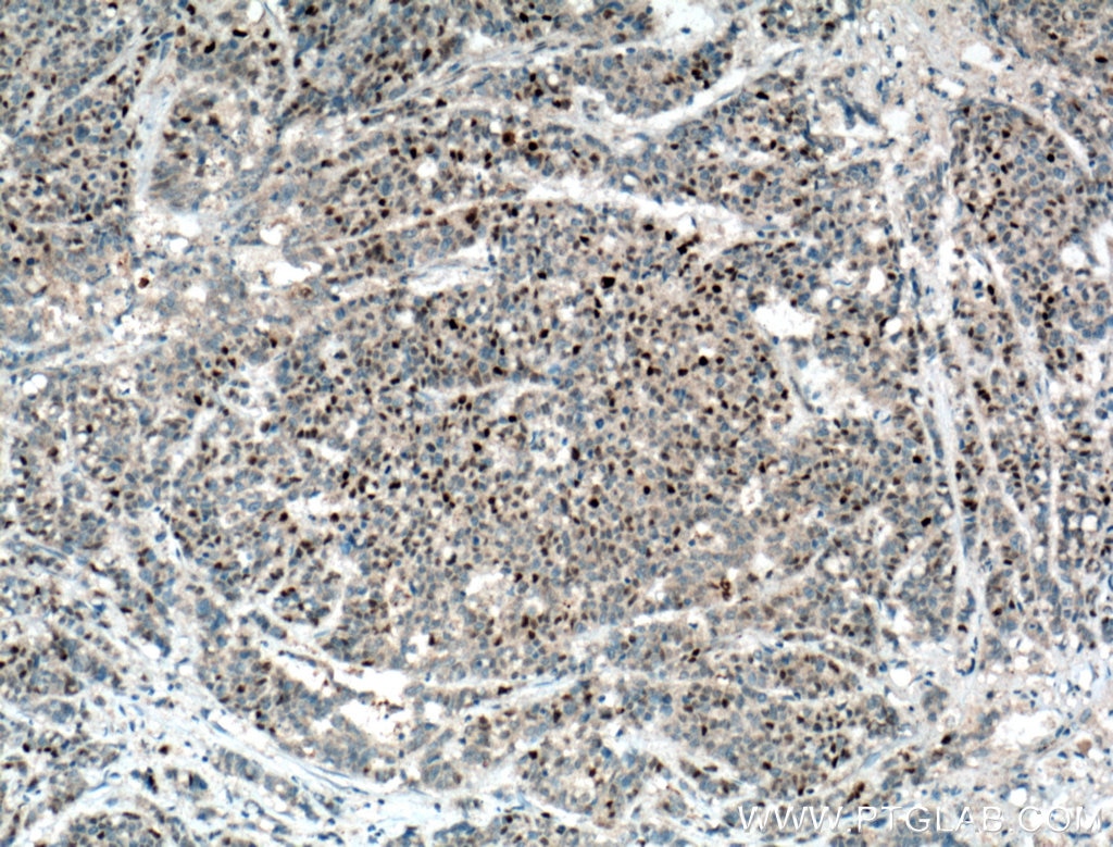 Immunohistochemistry (IHC) staining of human colon cancer tissue using P21 Polyclonal antibody (10355-1-AP)