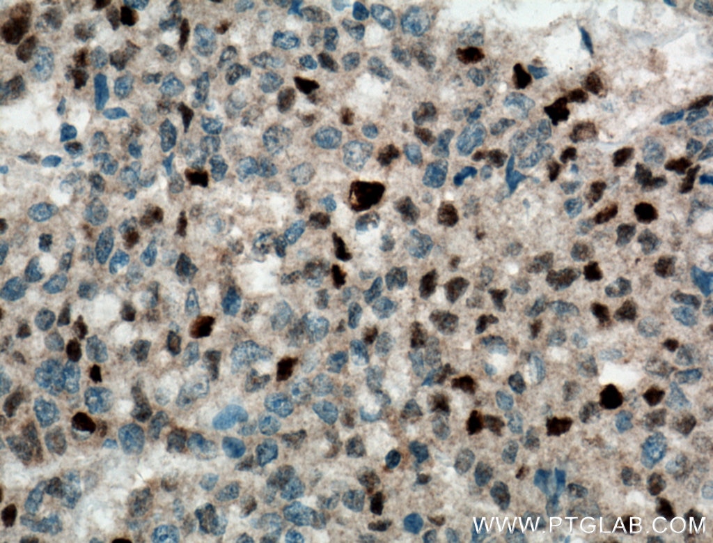 Immunohistochemistry (IHC) staining of human colon cancer tissue using P21 Polyclonal antibody (10355-1-AP)