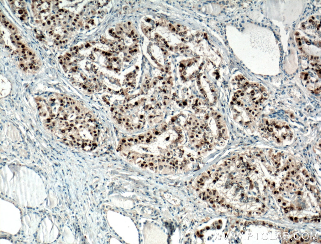Immunohistochemistry (IHC) staining of human thyroid cancer tissue using P21 Polyclonal antibody (10355-1-AP)