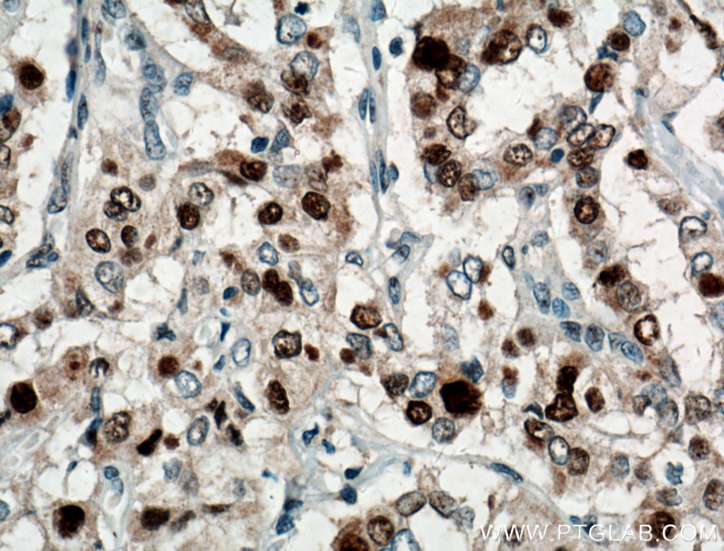 Immunohistochemistry (IHC) staining of human thyroid cancer tissue using P21 Polyclonal antibody (10355-1-AP)