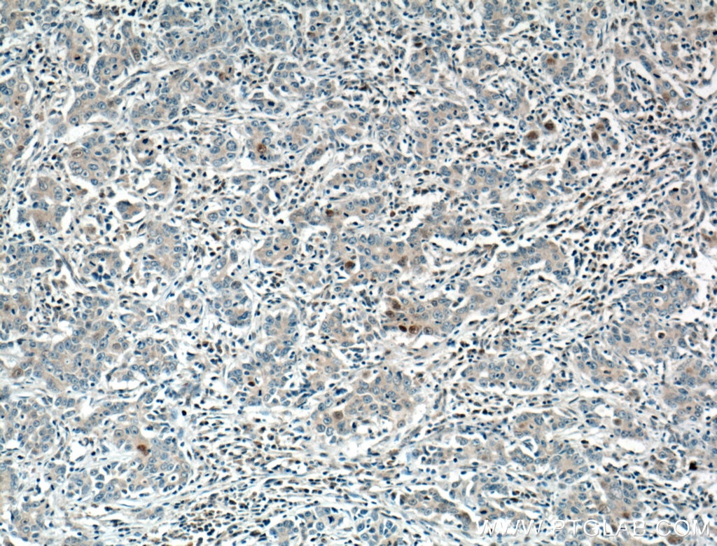 Immunohistochemistry (IHC) staining of human stomach cancer tissue using P21 Polyclonal antibody (10355-1-AP)