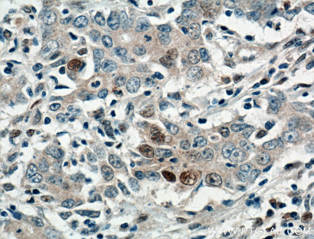 Immunohistochemistry (IHC) staining of human stomach cancer tissue using P21 Polyclonal antibody (10355-1-AP)