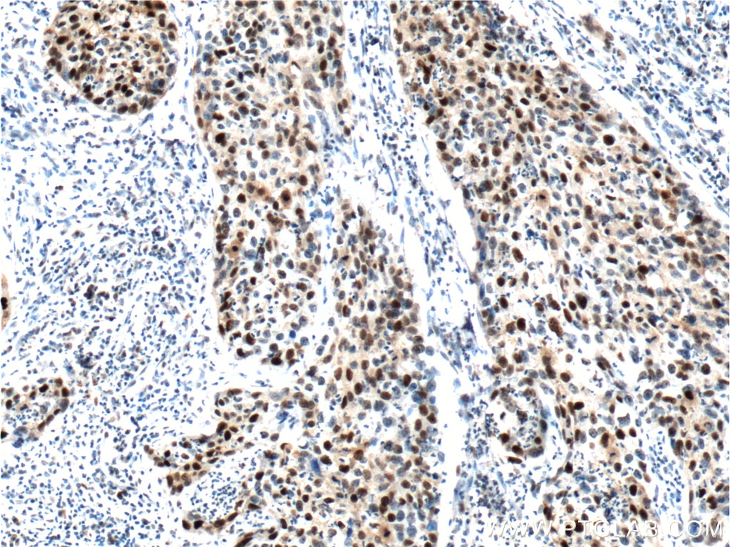 Immunohistochemistry (IHC) staining of human cervical cancer tissue using P21 Polyclonal antibody (10355-1-AP)