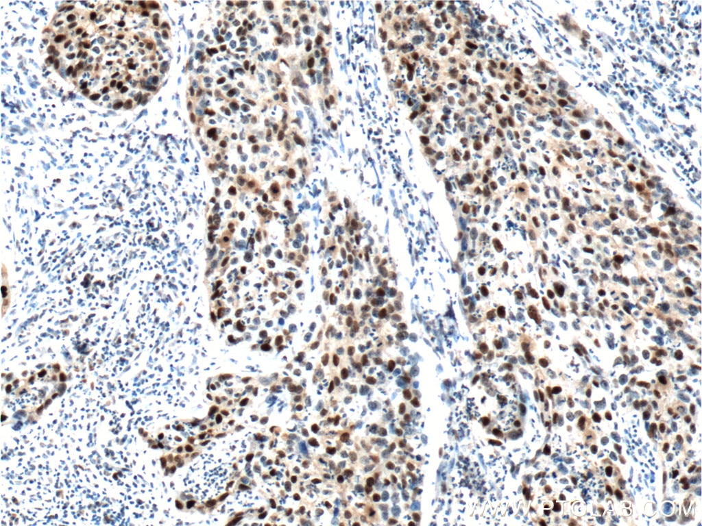 IHC staining of human cervical cancer using 10355-1-AP