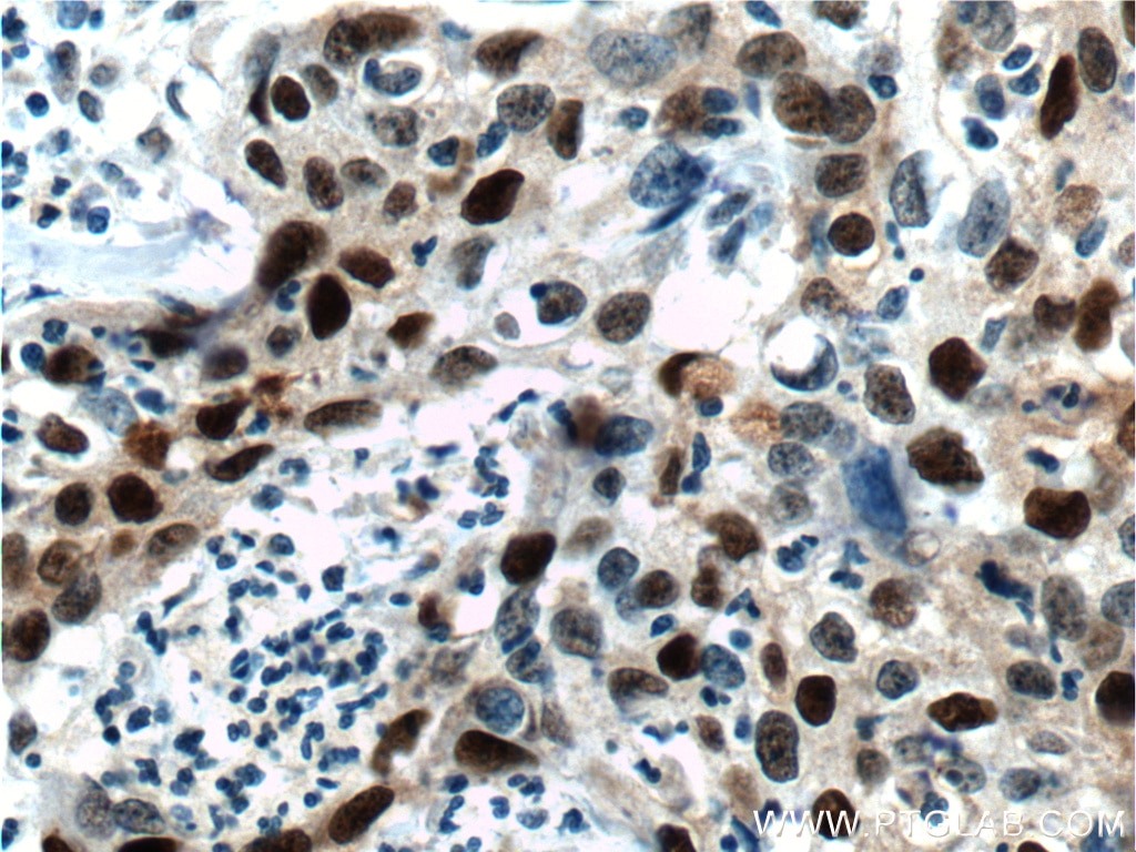 Immunohistochemistry (IHC) staining of human cervical cancer tissue using P21 Polyclonal antibody (10355-1-AP)