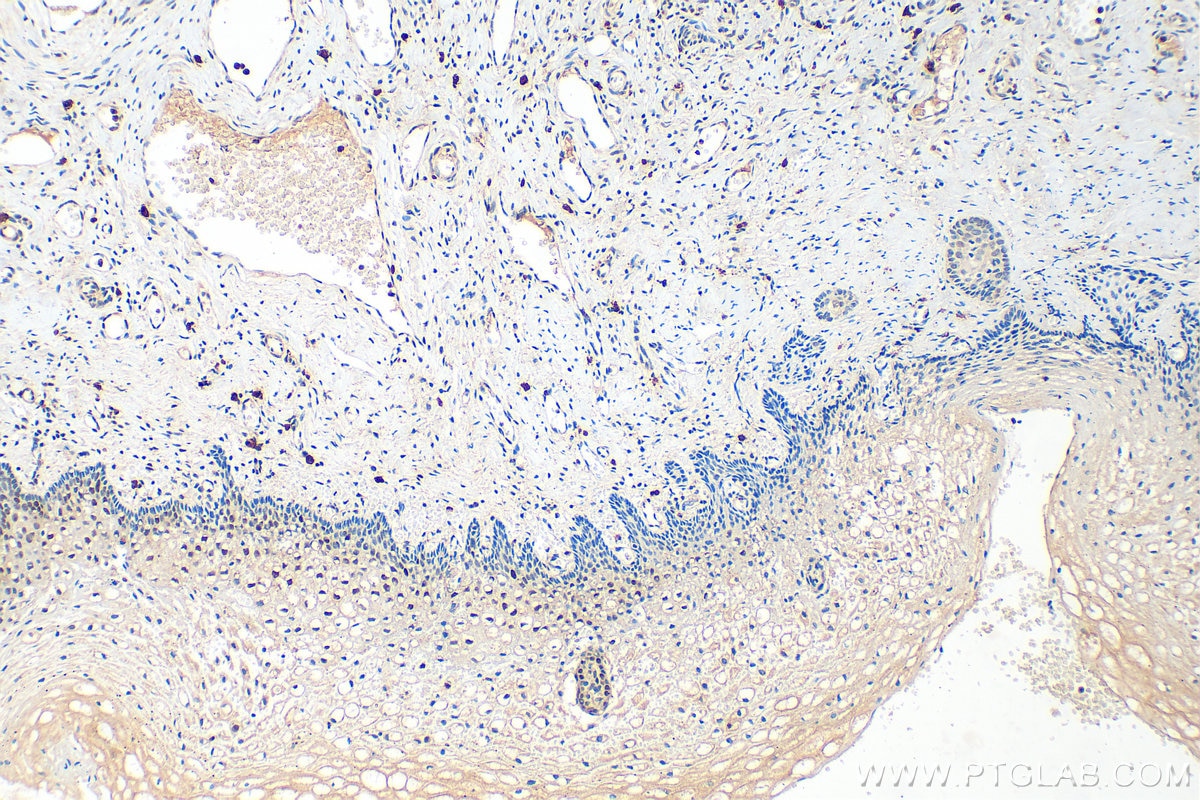 Immunohistochemistry (IHC) staining of human cervical cancer tissue using P21 Polyclonal antibody (10355-1-AP)