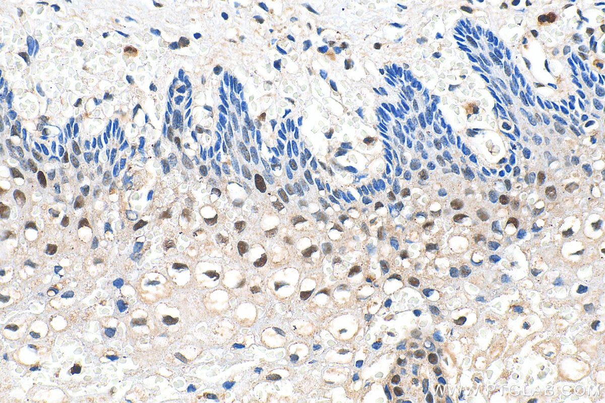 Immunohistochemistry (IHC) staining of human cervical cancer tissue using P21 Polyclonal antibody (10355-1-AP)