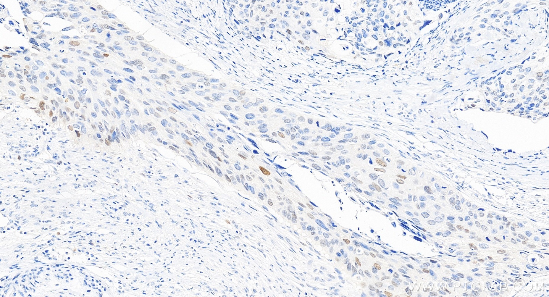 Immunohistochemical analysis of paraffin-embedded human cervical cancer tissue slide using 82669-2-RR (P21 antibody) at dilution of 1:400 (under 20x lens). Heat mediated antigen retrieval with Tris-EDTA buffer (pH 9.0). Immunohistochemistry (IHC) staining of human cervical cancer tissue using P21 Recombinant monoclonal antibody (82669-2-RR)