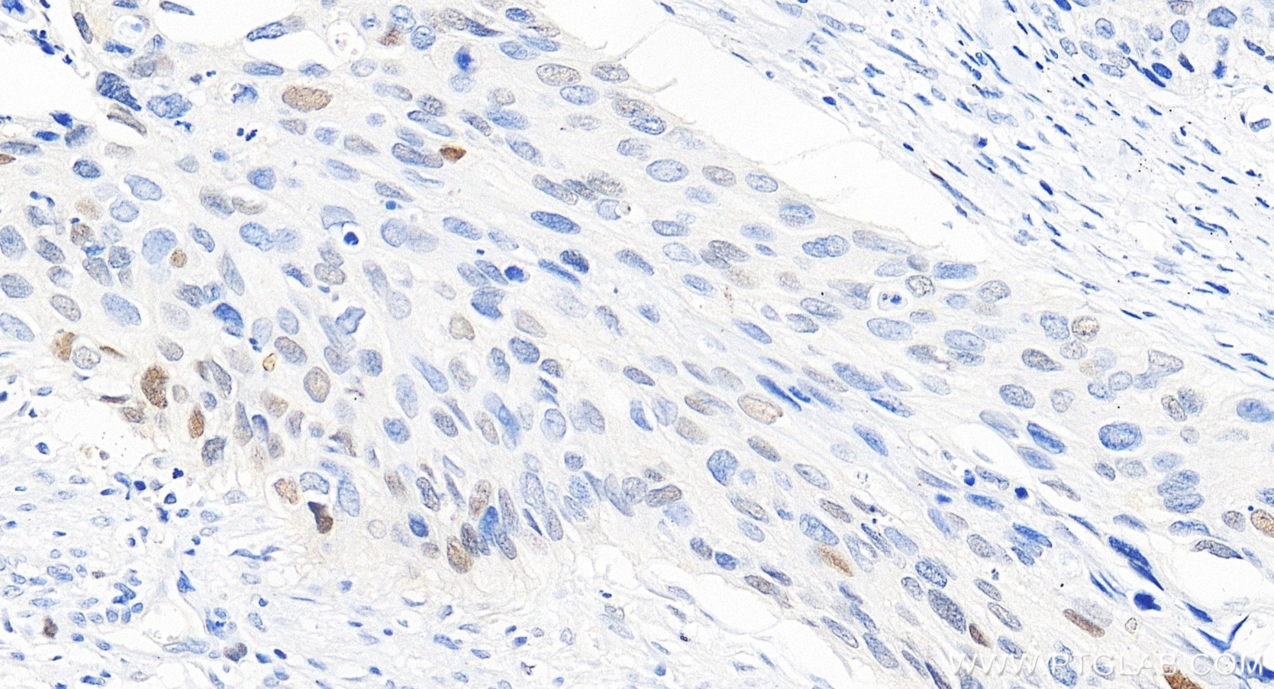 Immunohistochemical analysis of paraffin-embedded human cervical cancer tissue slide using 82669-2-RR (P21 antibody) at dilution of 1:400 (under 20x lens). Heat mediated antigen retrieval with Tris-EDTA buffer (pH 9.0). Immunohistochemistry (IHC) staining of human cervical cancer tissue using P21 Recombinant monoclonal antibody (82669-2-RR)