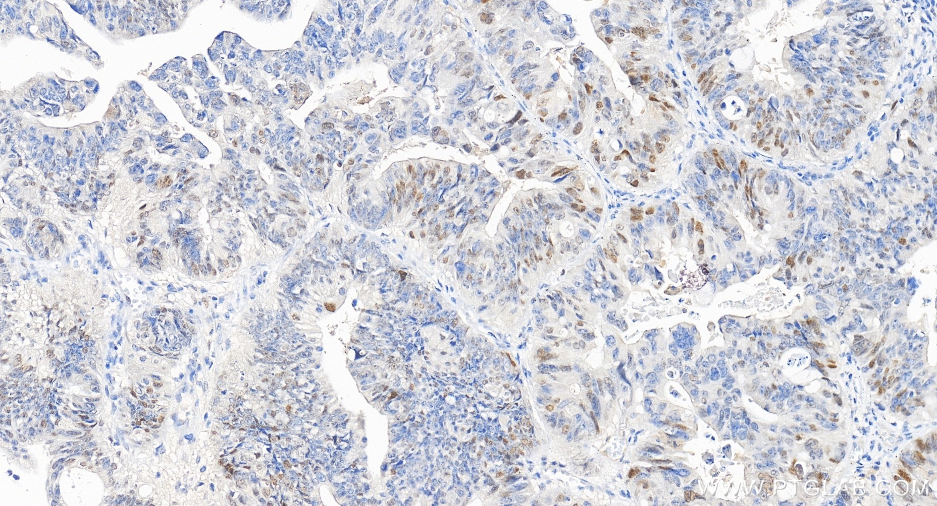 Immunohistochemical analysis of paraffin-embedded human colon cancer tissue slide using 82669-2-RR (P21 antibody) at dilution of 1:200 (under 20x lens). Heat mediated antigen retrieval with Tris-EDTA buffer (pH 9.0). Immunohistochemistry (IHC) staining of human colon cancer tissue using P21 Recombinant monoclonal antibody (82669-2-RR)