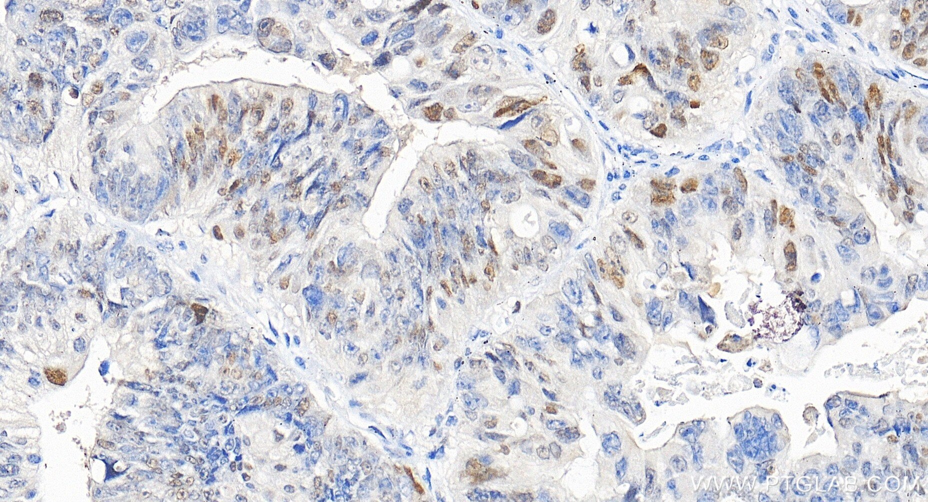 Immunohistochemical analysis of paraffin-embedded human colon cancer tissue slide using 82669-2-RR (P21 antibody) at dilution of 1:200 (under 20x lens). Heat mediated antigen retrieval with Tris-EDTA buffer (pH 9.0). Immunohistochemistry (IHC) staining of human colon cancer tissue using P21 Recombinant monoclonal antibody (82669-2-RR)