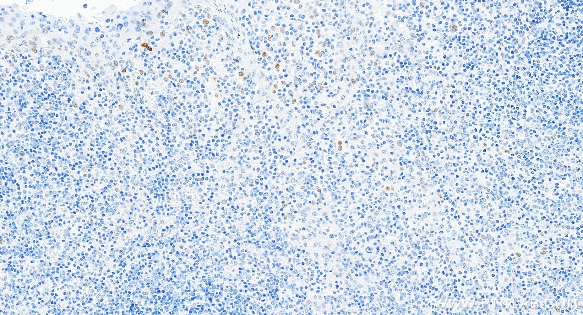 Immunohistochemical analysis of paraffin-embedded human tonsillitis tissue slide using 82669-2-RR (P21 antibody) at dilution of 1:200 (under 20x lens). Heat mediated antigen retrieval with Tris-EDTA buffer (pH 9.0). Immunohistochemistry (IHC) staining of human tonsillitis tissue using P21 Recombinant monoclonal antibody (82669-2-RR)