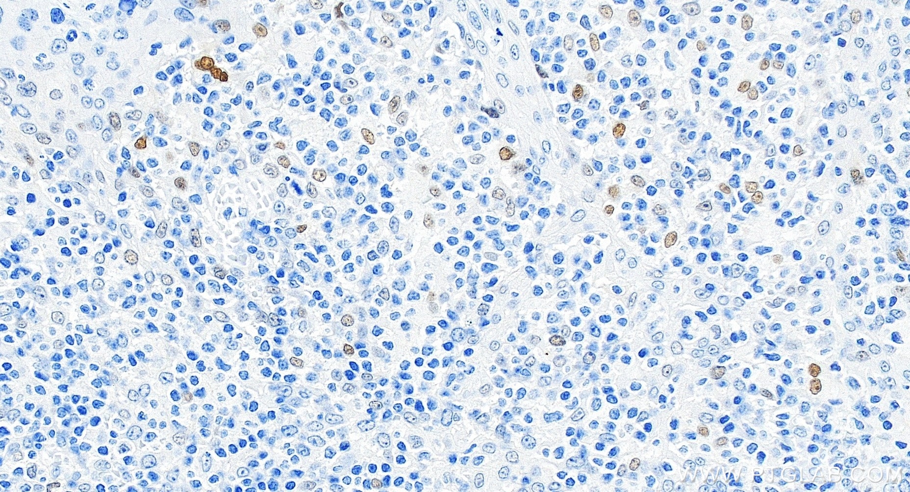 Immunohistochemical analysis of paraffin-embedded human tonsillitis tissue slide using 82669-2-RR (P21 antibody) at dilution of 1:200 (under 20x lens). Heat mediated antigen retrieval with Tris-EDTA buffer (pH 9.0). Immunohistochemistry (IHC) staining of human tonsillitis tissue using P21 Recombinant monoclonal antibody (82669-2-RR)