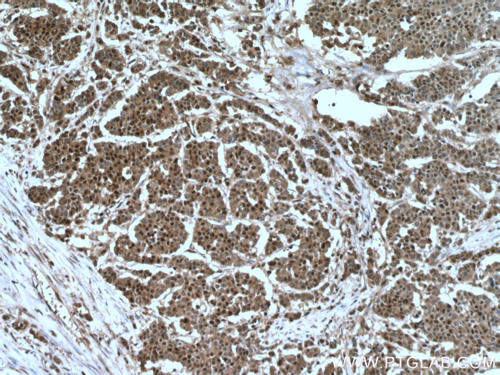 Immunohistochemistry (IHC) staining of human colon cancer tissue using P27; KIP1 Polyclonal antibody (25614-1-AP)