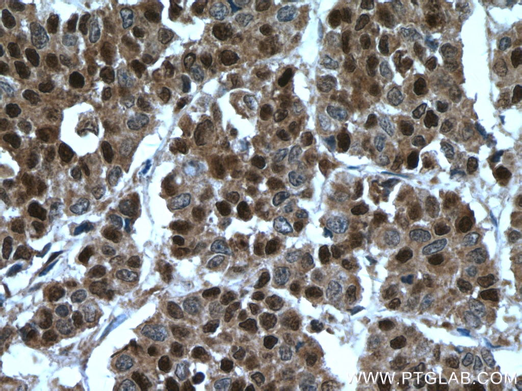 Immunohistochemistry (IHC) staining of human colon cancer tissue using P27; KIP1 Polyclonal antibody (25614-1-AP)