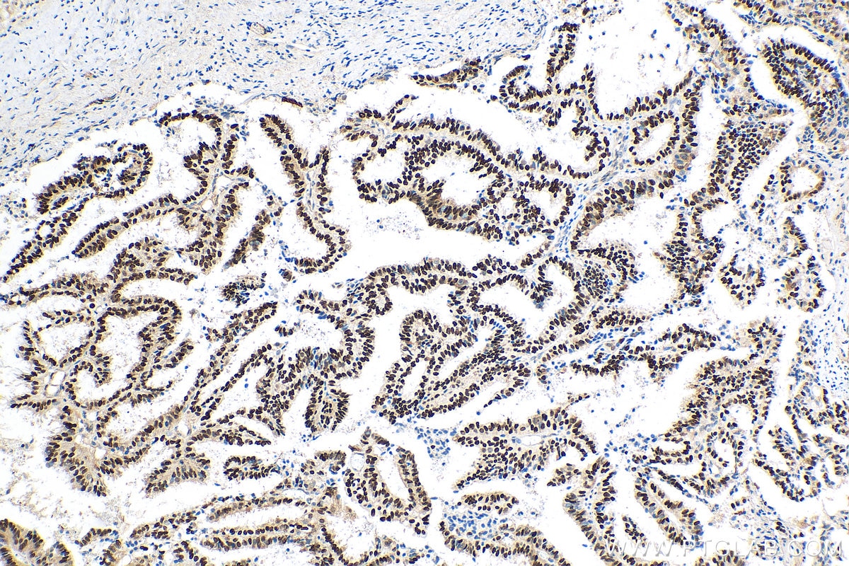 IHC staining of human ovary tumor using 25614-1-AP