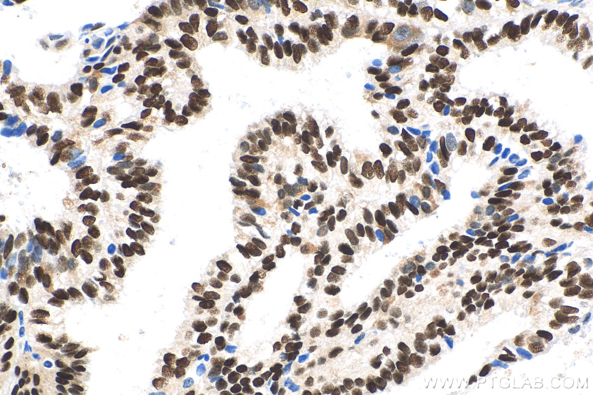 Immunohistochemistry (IHC) staining of human ovary tumor tissue using P27; KIP1 Polyclonal antibody (25614-1-AP)