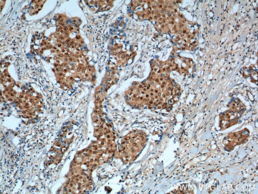 Immunohistochemistry (IHC) staining of human breast cancer tissue using P27; KIP1 Polyclonal antibody (25614-1-AP)