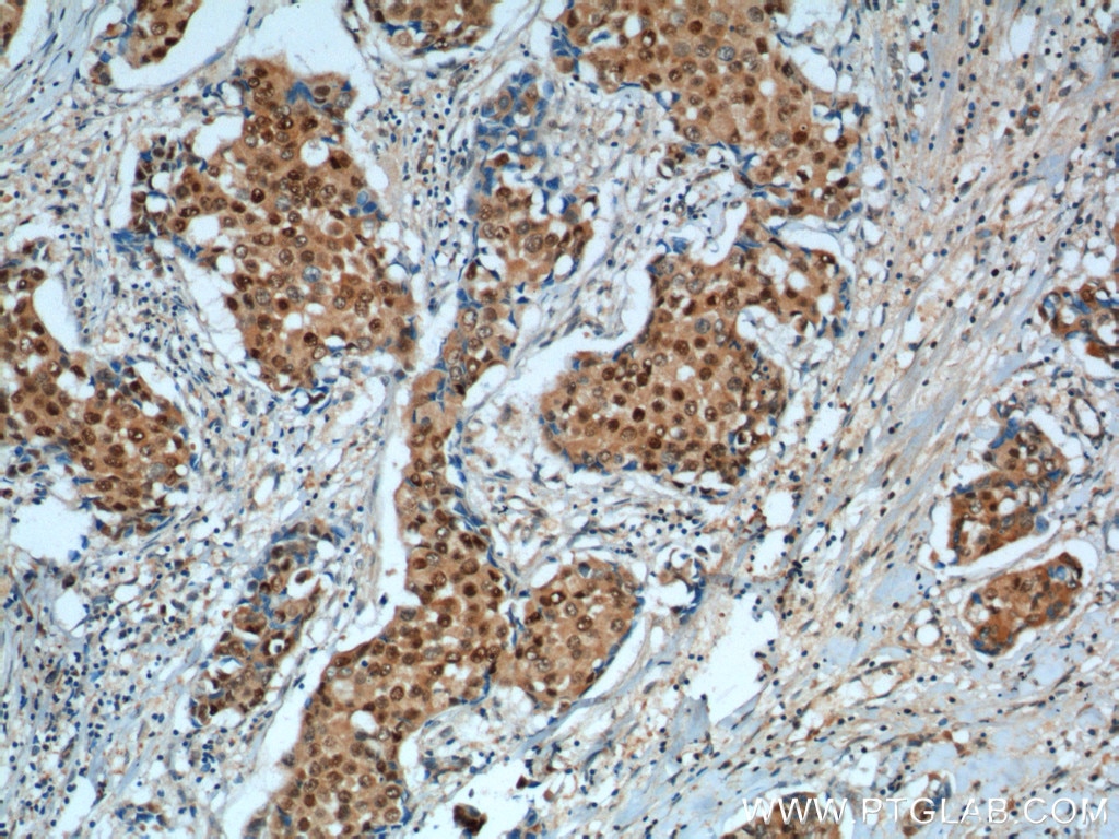 IHC staining of human breast cancer using 25614-1-AP