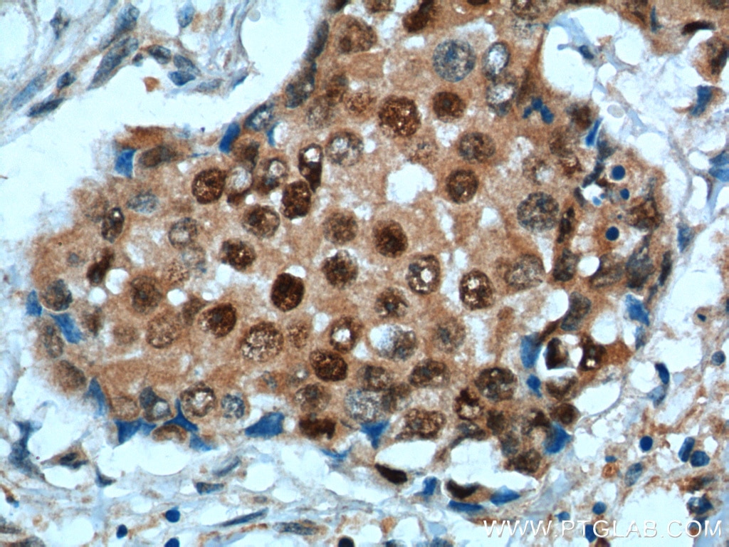 Immunohistochemistry (IHC) staining of human breast cancer tissue using P27; KIP1 Polyclonal antibody (25614-1-AP)