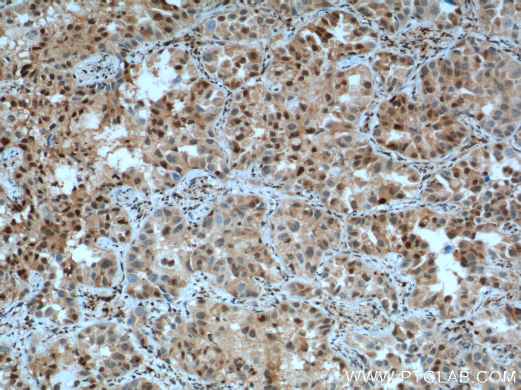 Immunohistochemistry (IHC) staining of human lung cancer tissue using P27; KIP1 Polyclonal antibody (25614-1-AP)
