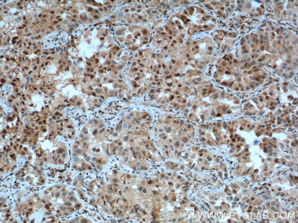 IHC staining of human lung cancer using 25614-1-AP