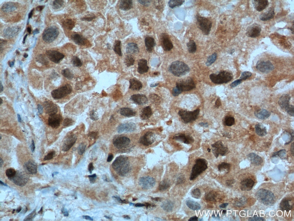 Immunohistochemistry (IHC) staining of human lung cancer tissue using P27; KIP1 Polyclonal antibody (25614-1-AP)