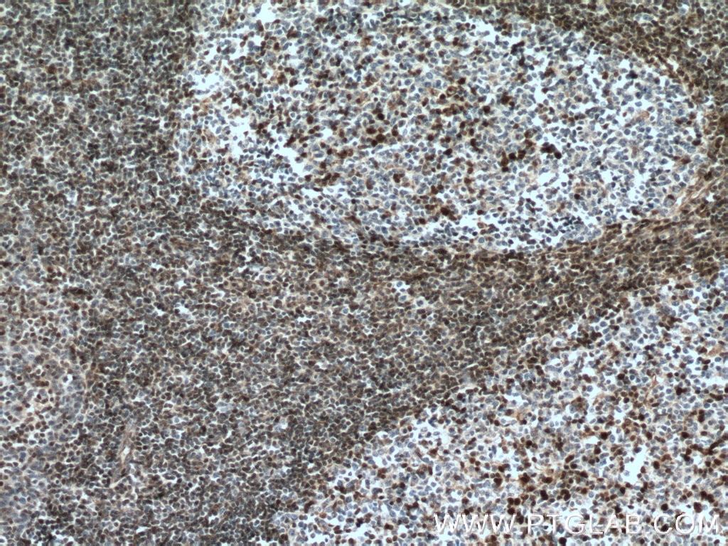 Immunohistochemistry (IHC) staining of human tonsillitis tissue using P27; KIP1 Polyclonal antibody (26714-1-AP)