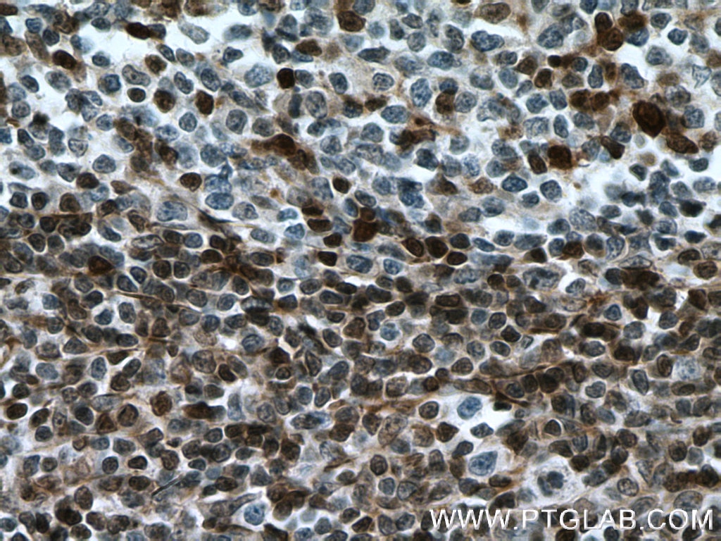 Immunohistochemistry (IHC) staining of human tonsillitis tissue using P27; KIP1 Polyclonal antibody (26714-1-AP)