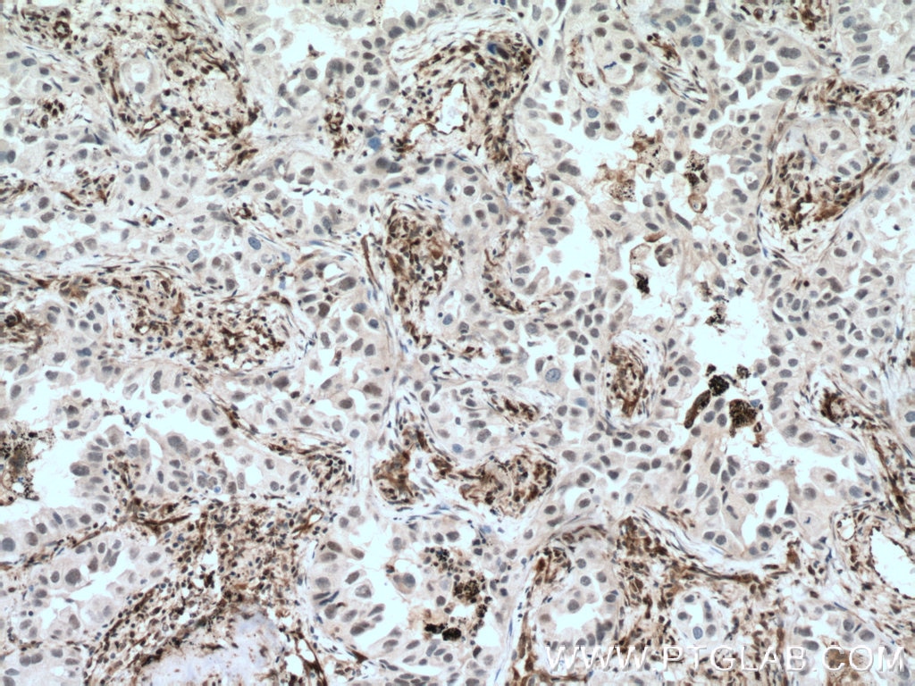 Immunohistochemistry (IHC) staining of human lung cancer tissue using P27; KIP1 Polyclonal antibody (26714-1-AP)