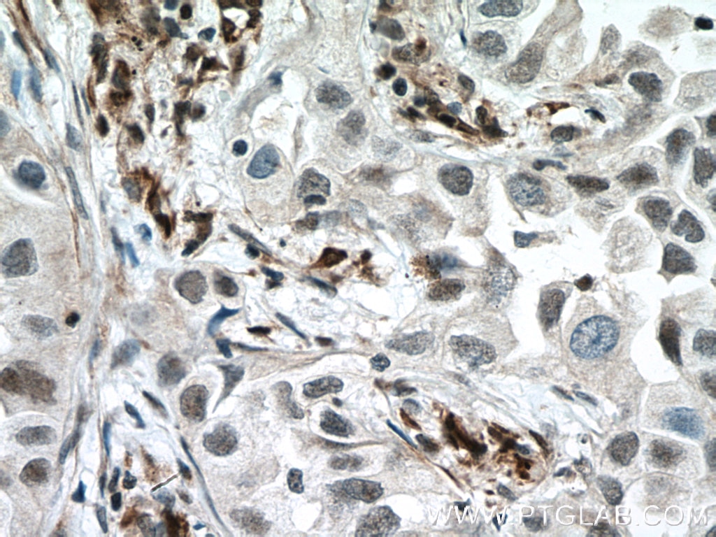Immunohistochemistry (IHC) staining of human lung cancer tissue using P27; KIP1 Polyclonal antibody (26714-1-AP)