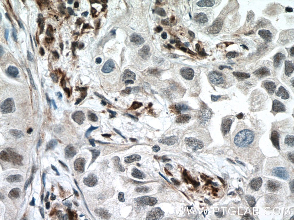 IHC staining of human lung cancer using 26714-1-AP