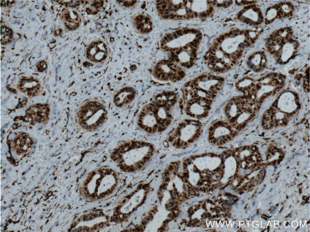 Immunohistochemistry (IHC) staining of human breast cancer tissue using P27; KIP1 Polyclonal antibody (26714-1-AP)