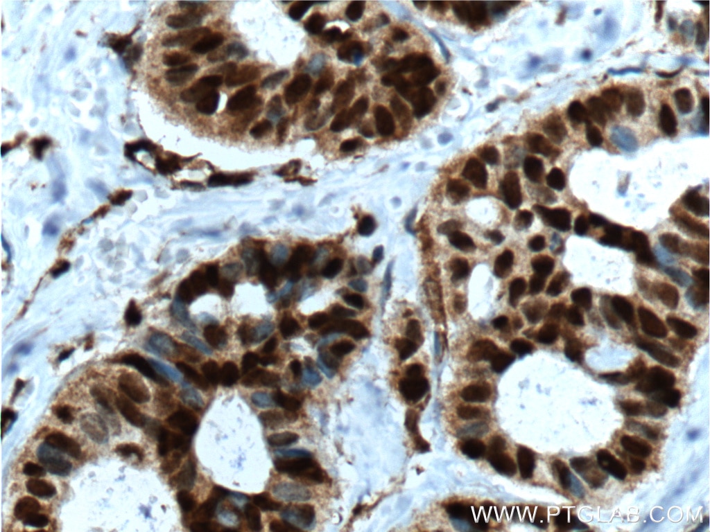 Immunohistochemistry (IHC) staining of human breast cancer tissue using P27; KIP1 Polyclonal antibody (26714-1-AP)