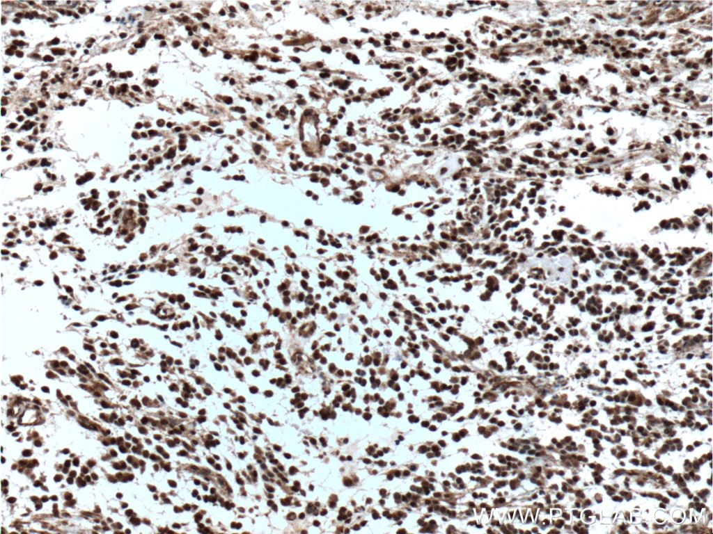 Immunohistochemistry (IHC) staining of human gliomas tissue using P27; KIP1 Polyclonal antibody (26714-1-AP)