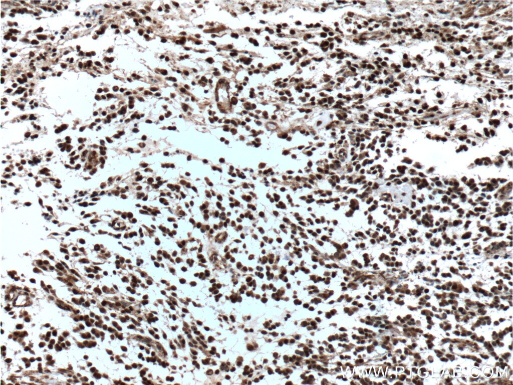 IHC staining of human gliomas using 26714-1-AP