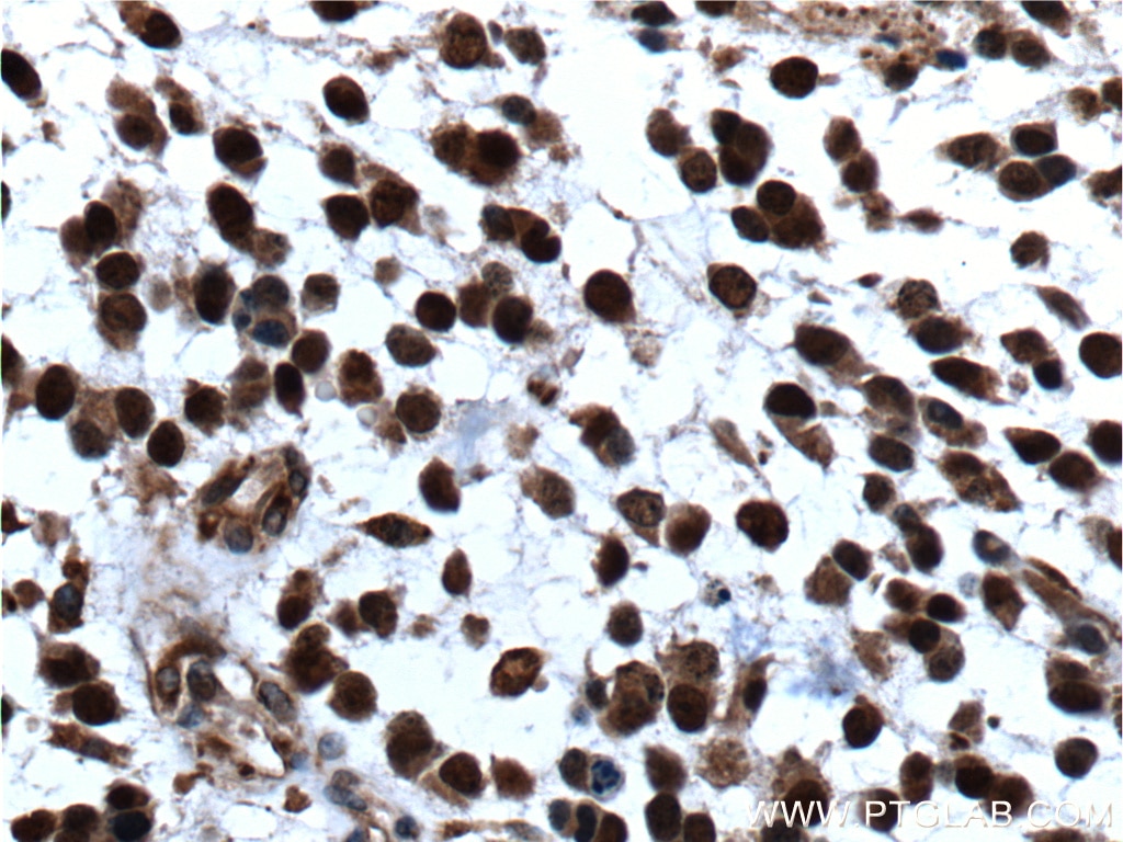 Immunohistochemistry (IHC) staining of human gliomas tissue using P27; KIP1 Polyclonal antibody (26714-1-AP)
