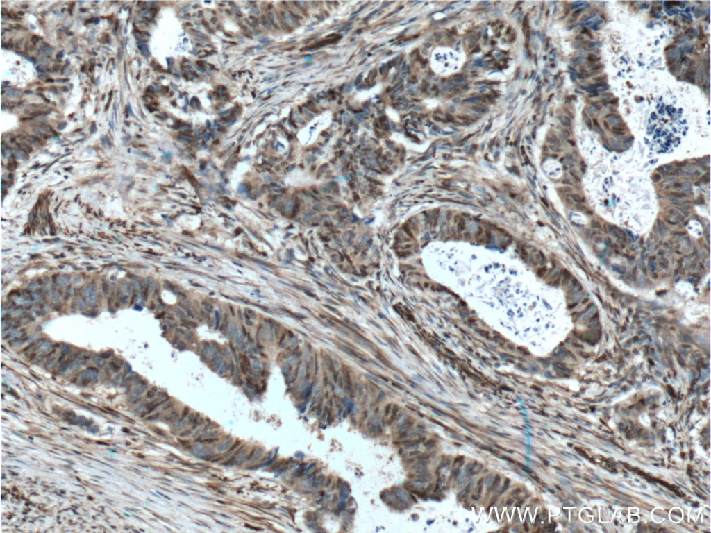 Immunohistochemistry (IHC) staining of human colon cancer tissue using P27; KIP1 Polyclonal antibody (26714-1-AP)