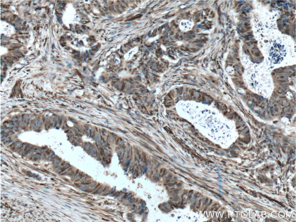 IHC staining of human colon cancer using 26714-1-AP