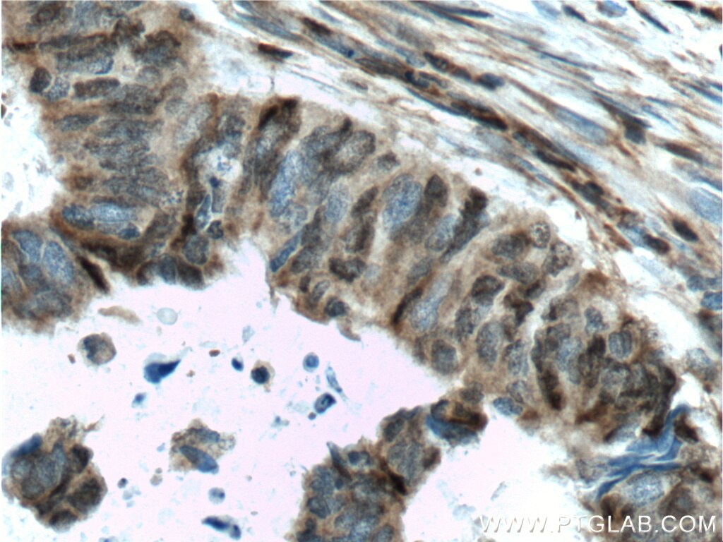 Immunohistochemistry (IHC) staining of human colon cancer tissue using P27; KIP1 Polyclonal antibody (26714-1-AP)