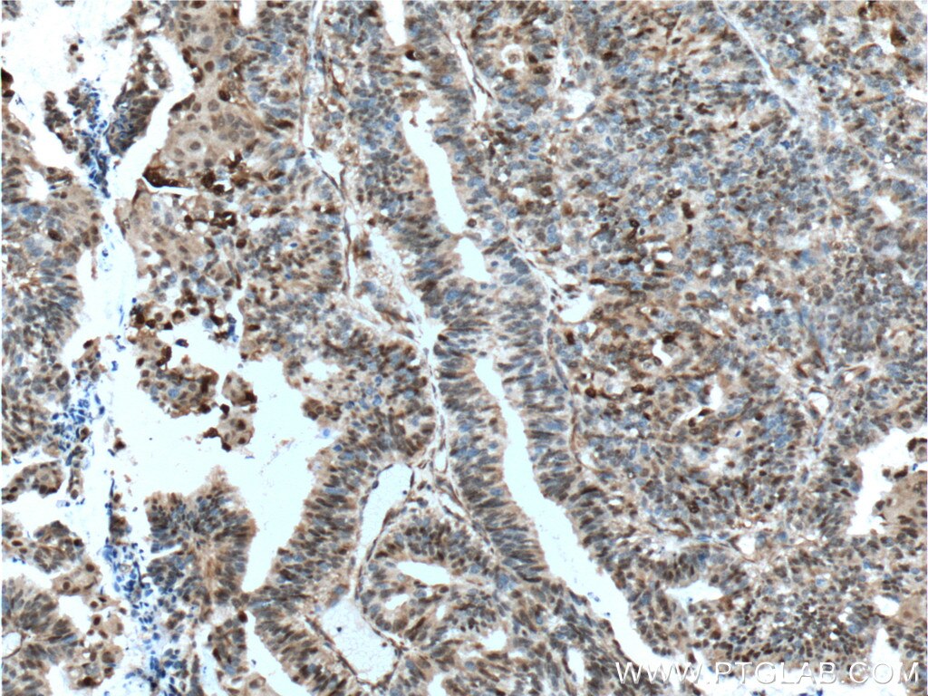 Immunohistochemistry (IHC) staining of human ovary tumor tissue using P27; KIP1 Polyclonal antibody (26714-1-AP)