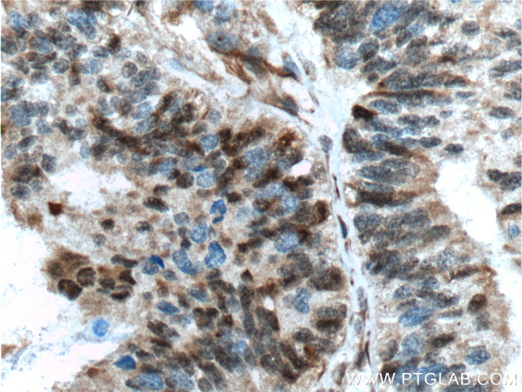 Immunohistochemistry (IHC) staining of human ovary tumor tissue using P27; KIP1 Polyclonal antibody (26714-1-AP)